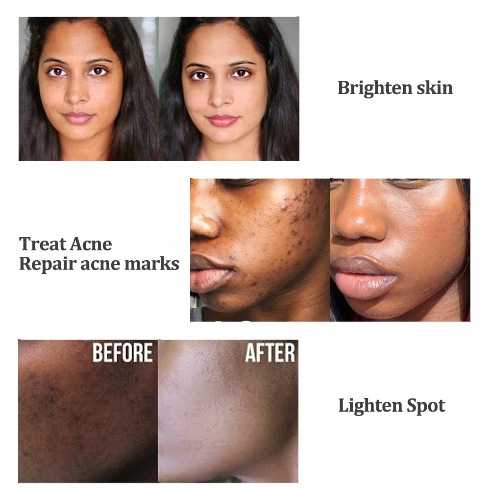 Turmeric Skin Whitening Cream for Dark Skin Acne Treatment Lighten Dark Spots Moisturizing Brightening Cream for Face Skin Care